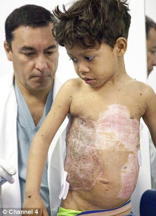 The Successfull Surgery For Turtle Boy