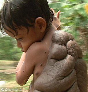 The Successfull Surgery For Turtle Boy